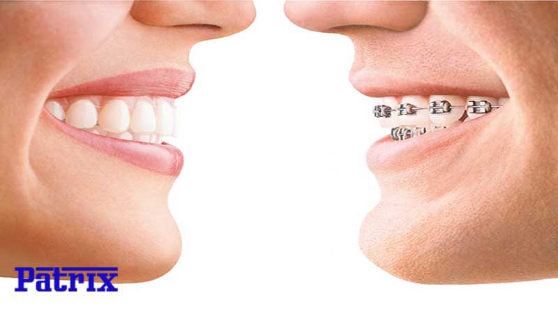 تفاوت نخ دندان معمولی با ارتودنسی