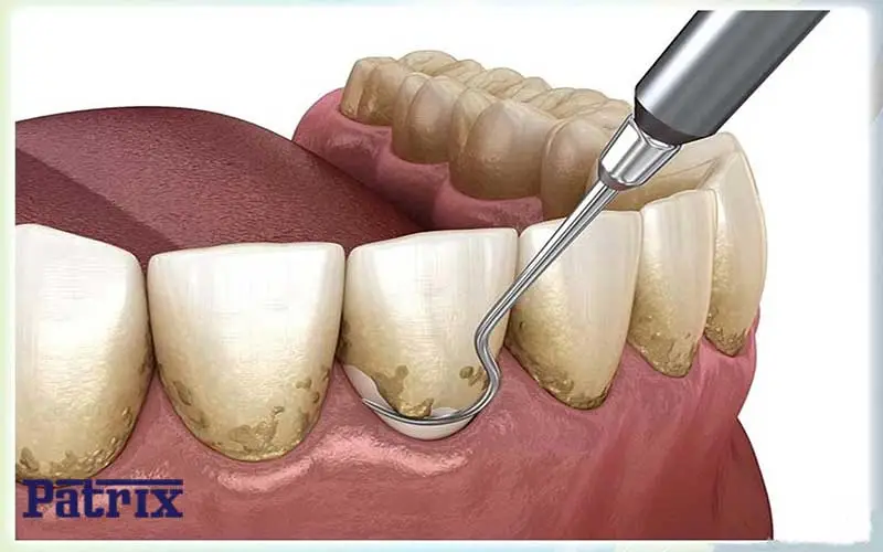 روش های از بین بردن پلاک دندان