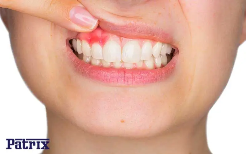 روش‌های پیشگیری از آبسه دندان