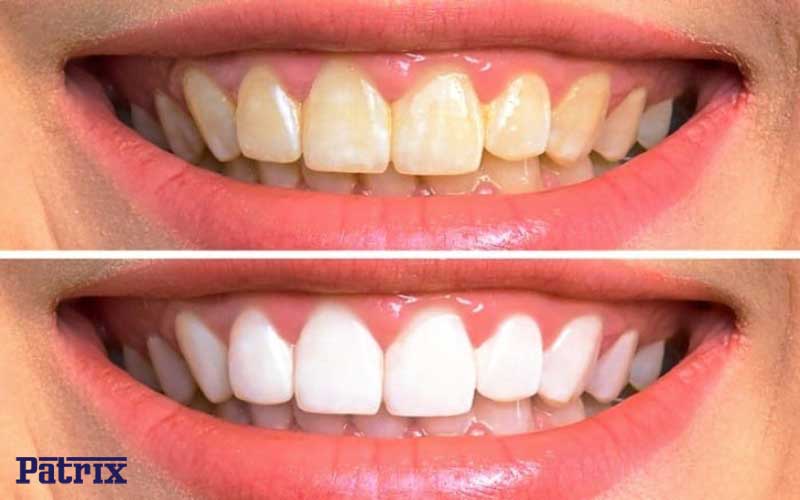 زردی دندان پس از کامپوزیت
