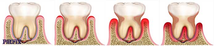 تحلیل لثه یعنی چه؟