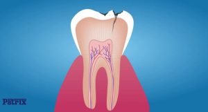 روش‌های جلوگیری از پوسیدگی دندان چیست؟